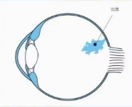 高度近視為什么易出現(xiàn)眼底出血