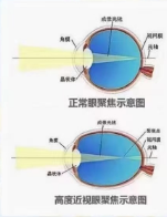 生活中如何避免高度近視并發癥