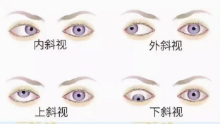 斜視的病因