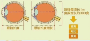 監測眼軸為什么能防控近視?