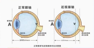 青少年眼軸為什么容易增長?