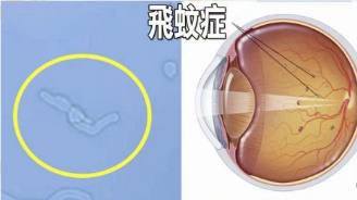 飛蚊癥和視網膜脫離的關系