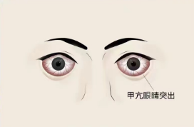 眼睛突然“變大”一定要小心