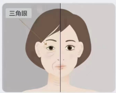 什么是年齡相關性眼臉松弛?