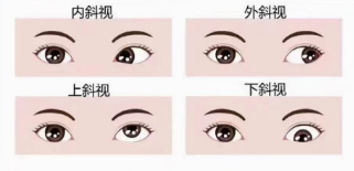 遠視會引起調(diào)節(jié)和集合聯(lián)動異常