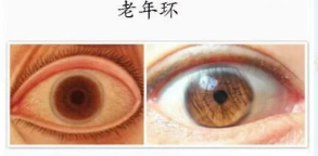 為什么老年人眼睛會有老年環?