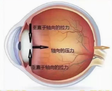 眼軸異常增長的原因之一