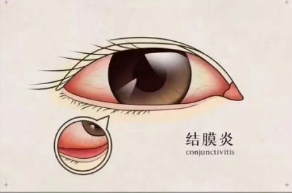 結膜炎會自愈嗎?