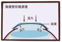 哪些人不適合佩戴角膜塑形鏡?
