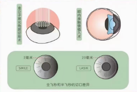 角膜屈光手術類型